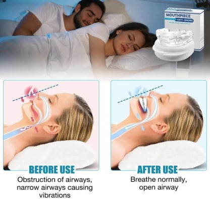 Anti-Snore Mouthpiece